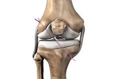 Anterior Cruciate Ligament Reconstruction