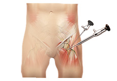 Hip Arthroscopy & Hip Preservation Procedures