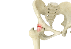 Hip Impingement