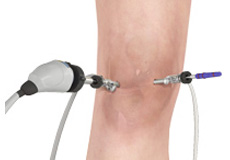 Knee Arthroscopy / Key Hole Knee Surgery