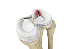 Knee Meniscal Tears