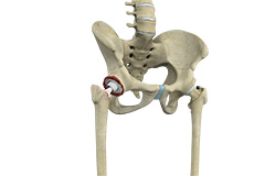 Revision Total Hip Replacement