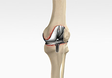 Revision Total Knee Replacement
