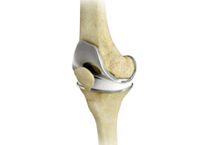 Total / Partial Knee Replacement